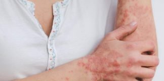 Cos'è la psoriasi